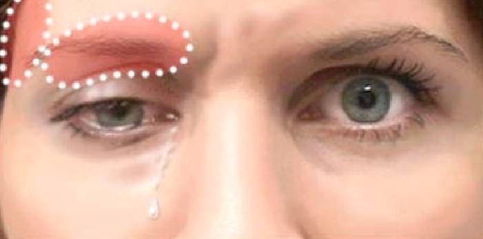Side-effects of Botox treatment