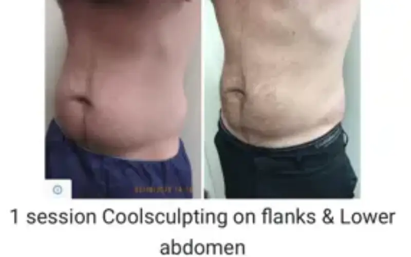 J Plasma Before And After