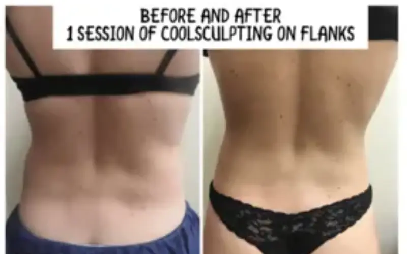 J Plasma Before And After