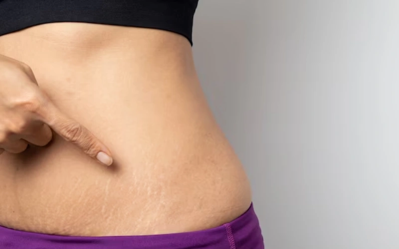 stretch mark microneedling