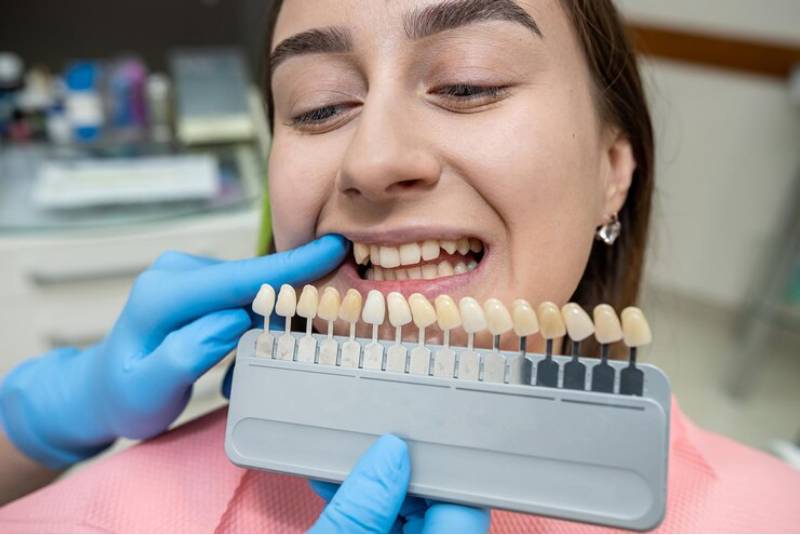dental bridges