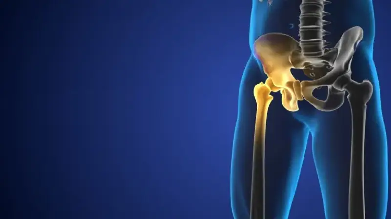 Hip Arthritis