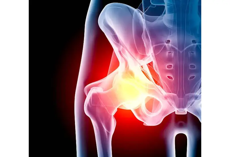 Hip Arthritis