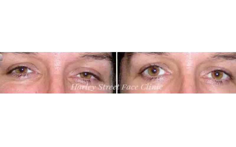 botox in london