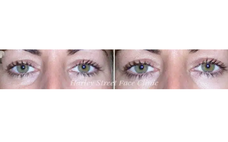botox in london