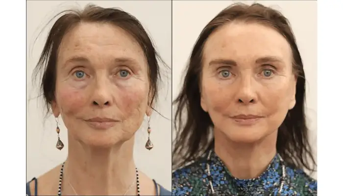 Deep plane facelift London