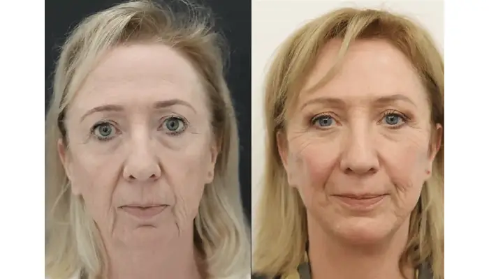Deep plane facelift London
